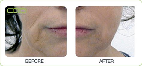 Caci Jowl Lift At Cheshire Lasers In Middlewich Cheshire