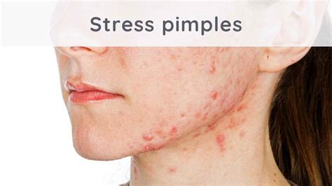 Stress Pimples What Solutions To Eliminate Them Stressapp