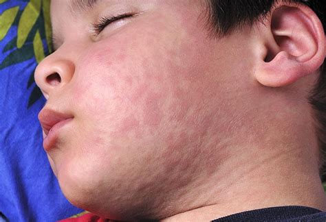 10 Maladies Infectieuses Courantes Que Votre Enfant Peut Attraper De