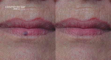 Venous Lake Blood Blister Lip Treatment London Vein Centre