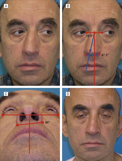 Effect Of Midfacial Asymmetry On Nasal Axis Deviation Indications For