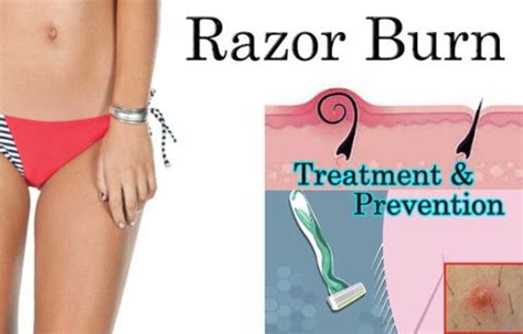 Trying to prevent razor bumps, ingrown hairs, and skin irritation? Top 10 Home Remedies to Get Rid of Razor Bumps