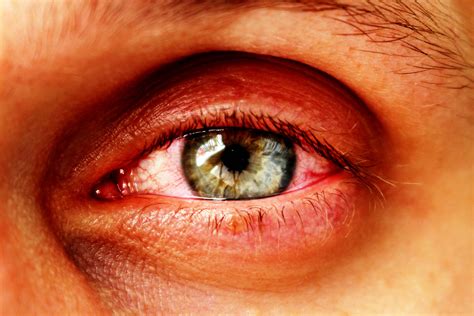 Do the covid vaccines not only keep the person from getting sick, but also from spreading the virus if exposed? Augeninfarkt - Ursachen, Symptome und Therapie - Heilpraxis