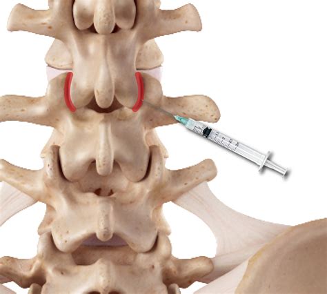 Facet Syndrome Lumbar And Cervical Arthrosis Joint Pain