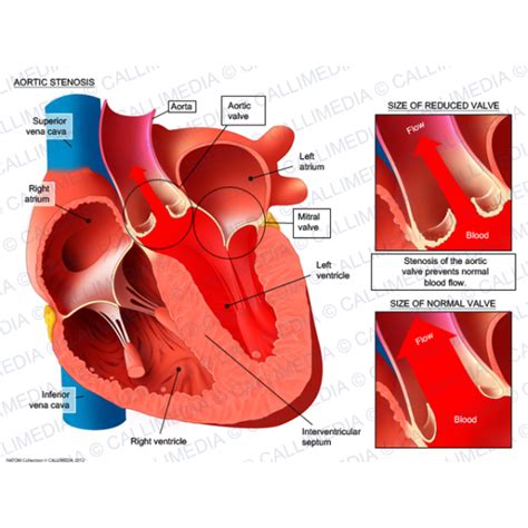 Aortic Stenosis Aortic Stenosis Stenosis Cardiac Disease