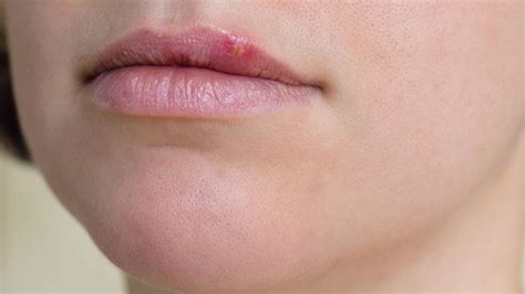 Cold Sore Bothering Your Use Hydrogen Peroxide For Cold Sores