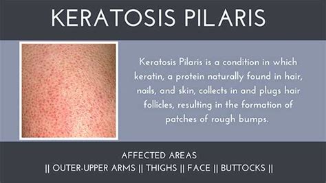 Keratosis Pilaris Skin Condition Contour Dermatology