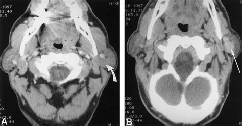 A Axial Ct Scan Of A Parotid Adenoma Arrow 5 Minutes After Iv