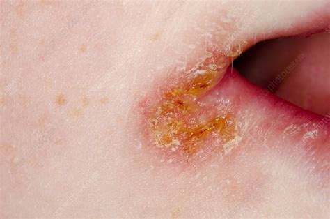 Skin Cracking Cheilitis At The Mouth Stock Image C0130889