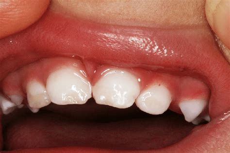 How i plan to remineralise and strengthen my kids teeth. Enamel hypoplasia of the deciduous incisors in a child ...