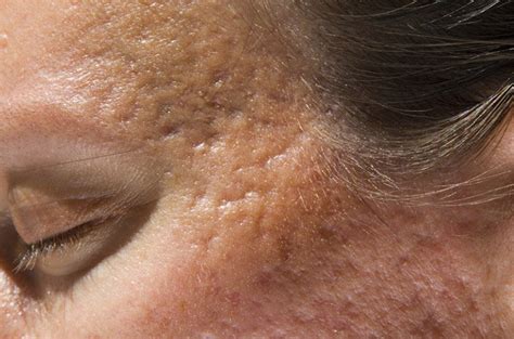 Acne Scar Types Of Skin Acne Scar Center Florida