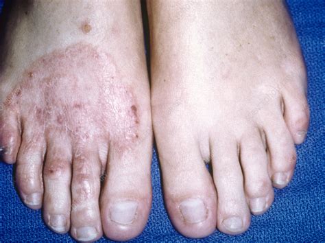 Ringworm Fungal Infection Of The Foot Stock Image C0235709