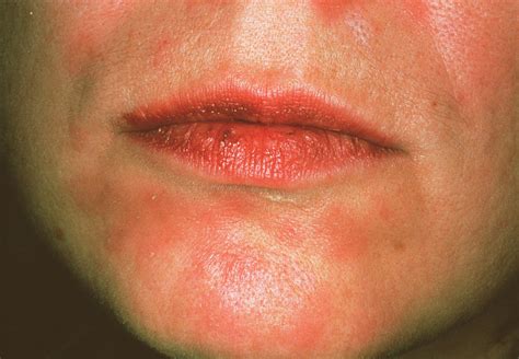 Secondary Syphilis Rash Photograph By Cnriscience Photo Library Pixels