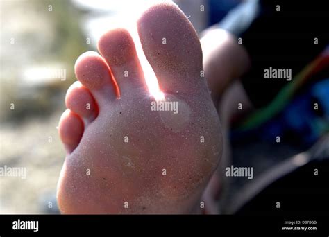 Young Woman With Blisters On The Soles Or Bottoms Of Her Feet Stock