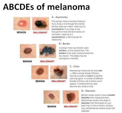 Cancer Malignant Melanoma Causes Symptoms Treatment
