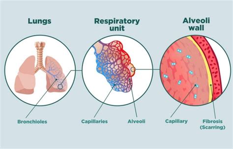 Understanding Ild Interstitial Lung Disease Program Stanford Medicine