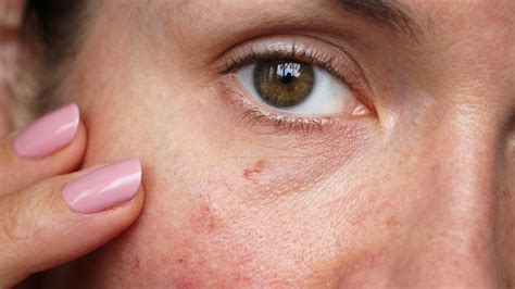 How To Get Rid Of Spider Veins On Your Face