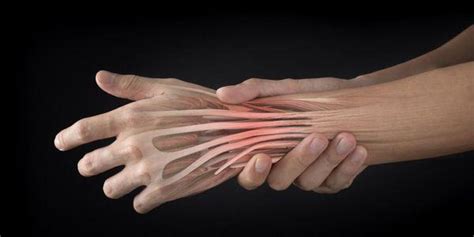 These tendons are found in hands and feet. Tendinite da articulação do punho: causas, sintomas ...