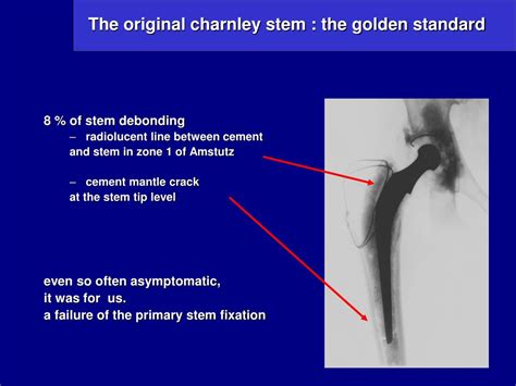 Ppt The Charnley Kerboull Hip System Results Of A 30 Years Experience