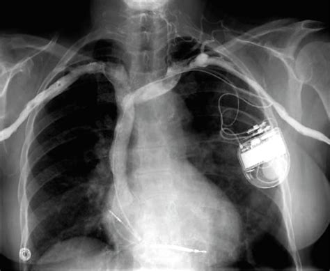 Cardiac Pacemaker Photograph By Zephyrscience Photo Library Pixels Merch