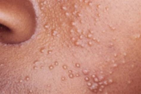 Common Causes Of Facial Rashes You Should Be Aware Of The Standard