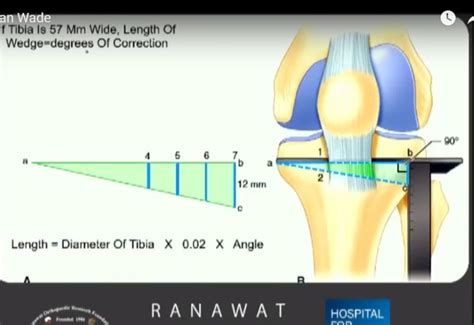 Closing Wedge High Tibial Osteotomy —