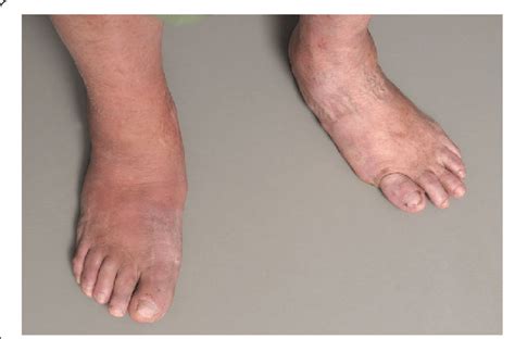 A Typical Charcot Foot In Acute Active Phase Red Hot And Swollen