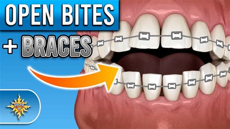 How Do Braces Fix Open Bites Premier Orthodontics Youtube