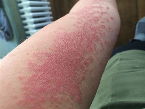 Woman Says She Cured Her Psoriasis By Following Plant Based Diet