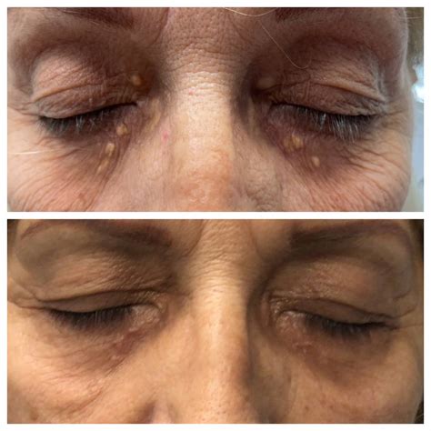 Xanthelasma Treatment St Louis Dermatology And Cosmetic Surgery