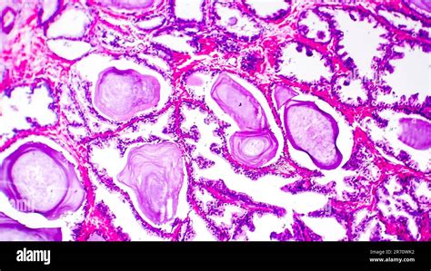 Histopatología De La Hiperplasia De La Glándula Prostática Micrografía