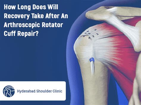 How Long Does Will Recovery Take After An Arthroscopic Rotator Cuff