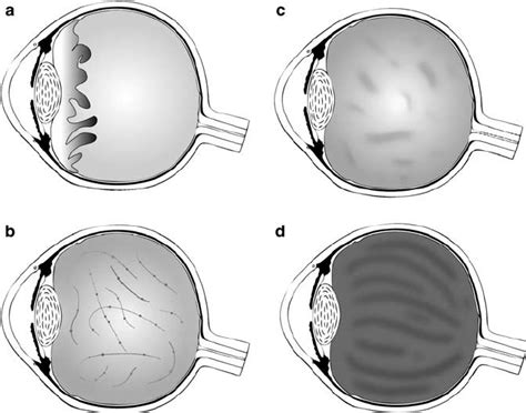 Schematic Illustration Of Vitreous Phenotypes A Top Left