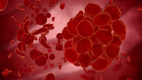 Deep Vein Thrombosis—the Blood Clot That Can Kill