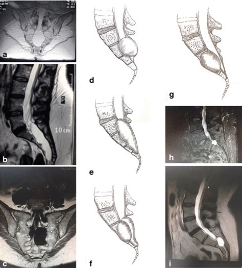 A Coronal Mr Image Of The Lumbosacral Spine Showing A Single Tarlov