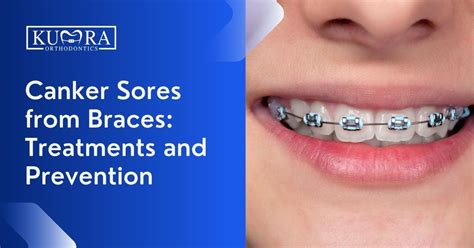 Canker Sores From Braces Treatments And Prevention Kumra Orthodontics