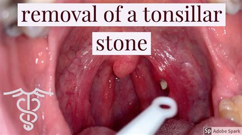 Removal Of A Tonsillar Stone Patient Education Video By Dr Carlo