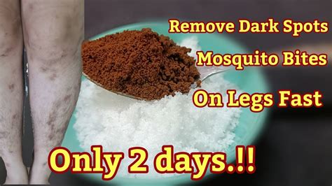 Remove Dark Spots Mosquito Bites Scar Hyperpigmentation On Legs Fast