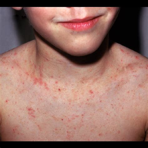 Scabies On Chest Pictures Photos