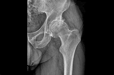 Recognizing And Diagnosing Avascular Necrosis Of The Hip In Primary Care Clinical Advisor