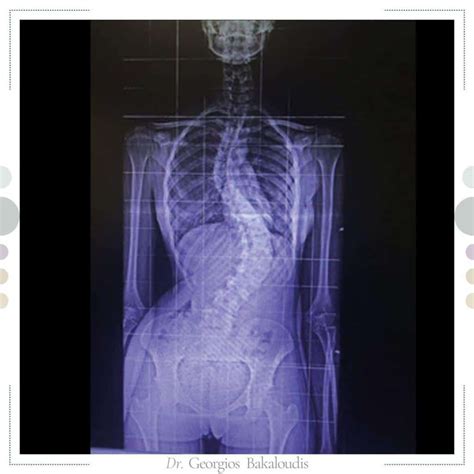 Intervento Chirurgico Scoliosi La Rivoluzione Mini Invasiva
