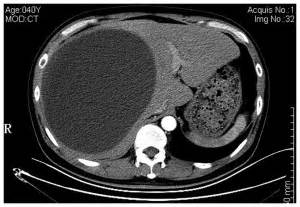 A Giant And Insidious Subphrenic Biloma Formation Due To Gallbladder