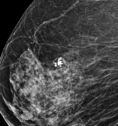 Popcorn Calcification Within The Breast Radiology Reference Article Radiopaedia Org