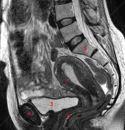 Normal Female Pelvis MRI Stock Image C Science Photo Library