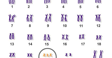 Angelman Syndrome Karyotype Chromosome 15 Acne Symptoms