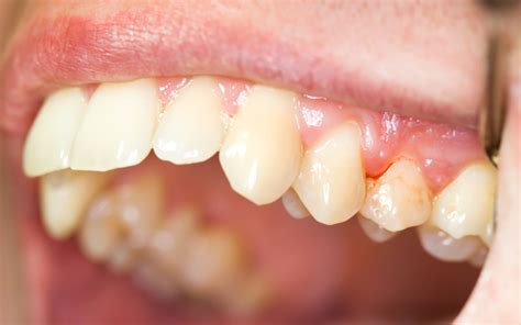 Common Causes Of Bleeding Gums Paducah Dentist