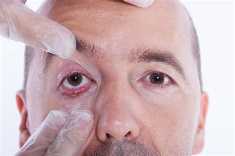 Jak leczyć jęczmień na oku Od czego robi się jęczmień na powiece i jakie powoduje objawy