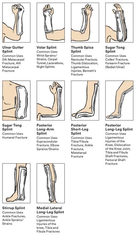 Splinting Guide Occupational Therapy Activities Ocupational Therapy