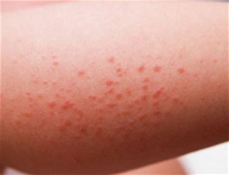 With tiny red spots on skin, having a dry skin can make the condition worse even unbearable. Red Bumps on Legs, Thighs, Like Pimples, Small, Itchy ...