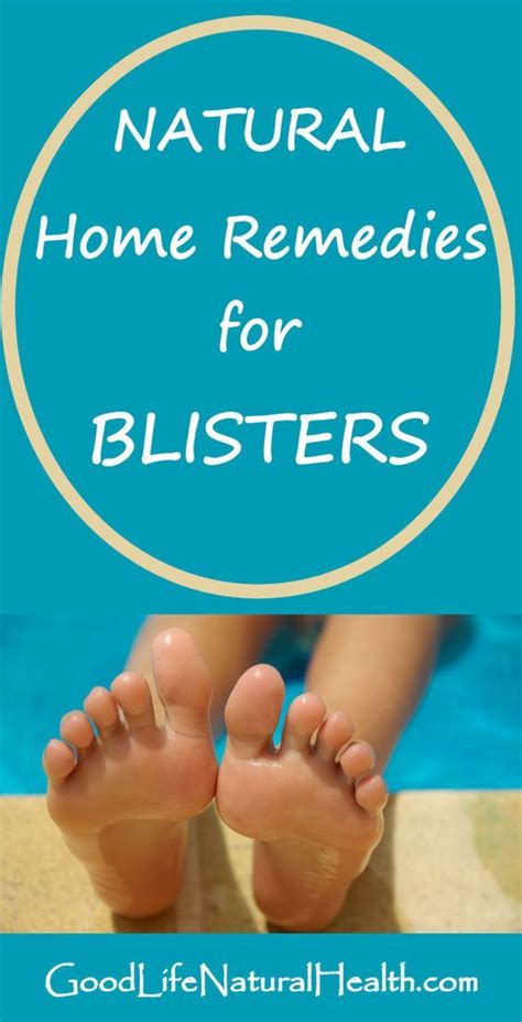 Pin By Becky On Health Natural Home Remedies Home Remedies Blister